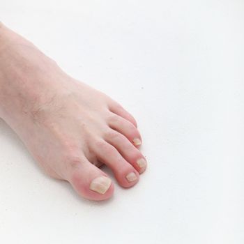 Psoriasis of the toenails with text space - square