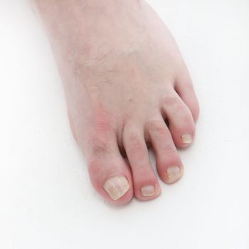 Psoriasis under the toenails - close-up-square