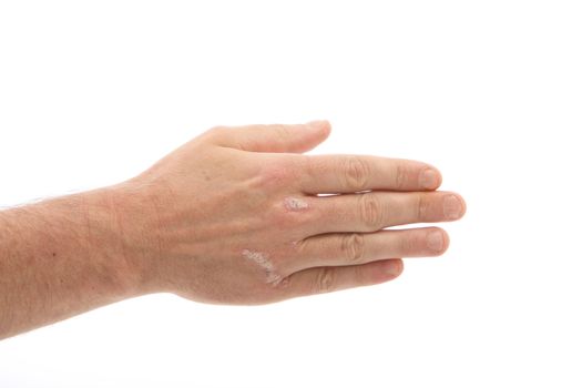Psoriasis on the hands and under fingernails with Copy Space