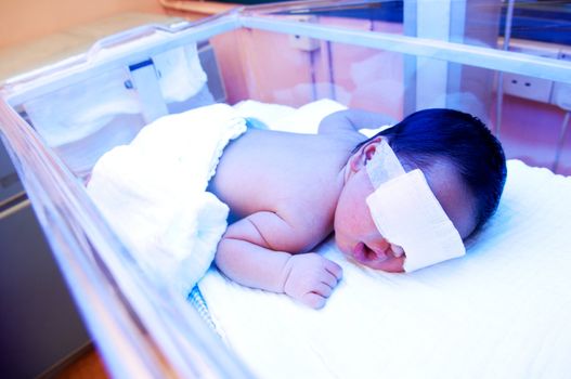 Newborn baby with jaundice under ultraviolet light in the incubator.