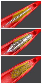 Balloon angioplasty procedure with placing a stent