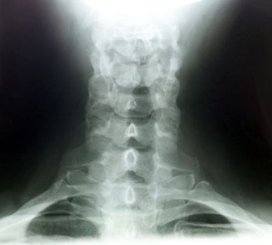 X-rays of the neck of a woman patient, showing bones or cervical vertebrae from the back.