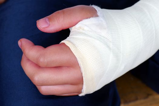 Broken hand in plaster cast with bandages, red, swollen fingers after an operation to fix the bones in place.