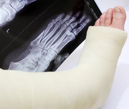 broken foot in a cast with xray of broken foot behind