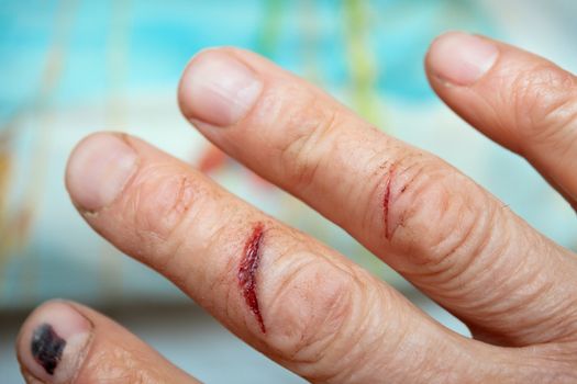 Traumatized by the fingers of the hand of the man