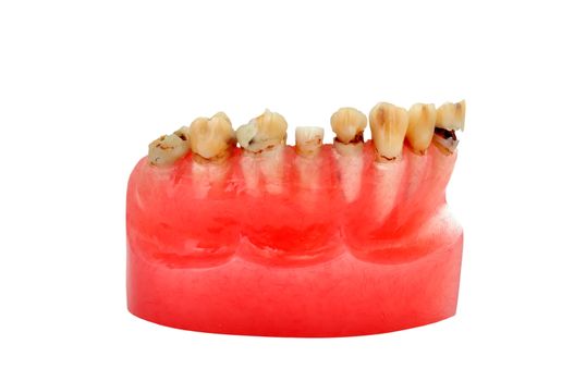 model of human jaw affected tooth decay