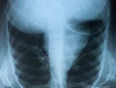 Chest X-ray medical image.