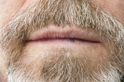 Hemangioma on the lip of an elderly man