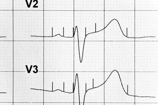 schedule of heart rate drawn by the modern medical device