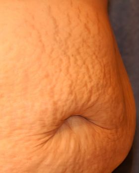 Post-pregnancy stretch marks and belly on white skin