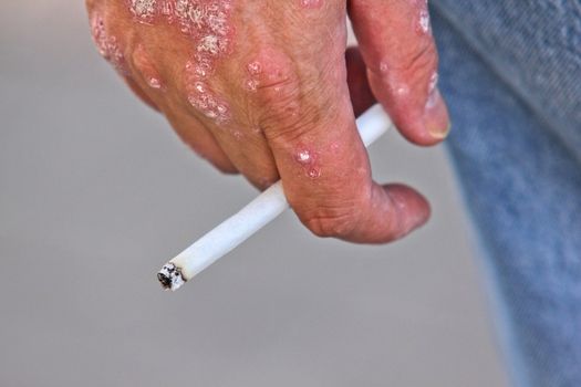 Person with psoriasis on it's hand, holding a lit cigarette between fingers, closeup