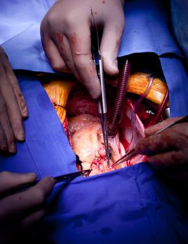 Detailed close-up of doctors hands performing heart operation