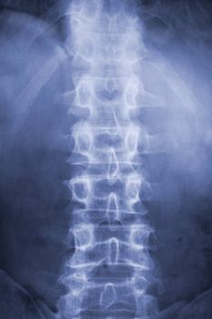spine and pelvis of a human body on x-ray