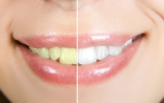 woman teeth before and after whitening