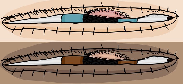 Two skin tones of stye on human eye