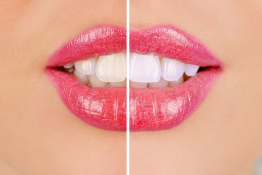 woman teeth before and after whitening