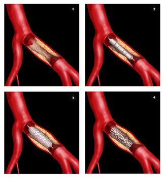 coronary stent surgical intervention in cardiothoracic technique