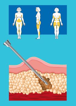 illustration of liposuction intervention with liposculpture in a woman