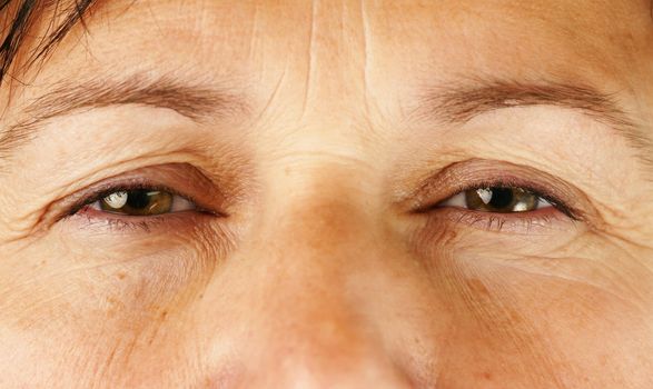 Healthcare, medical or aging concept: swollen red eyes of a wrinkly middle age woman, perfect for allergies, eye infection, cold and the likes.