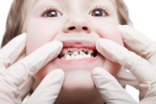 Dental medicine and healthcare - human patient open mouth showing caries teeth decay