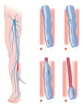 endovenous laser treatment varicose vein ablation