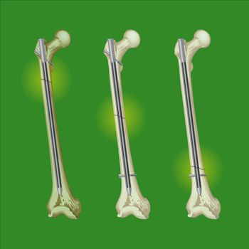 femur fracture surgical intervention in orthopedics technique