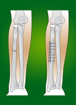 radius fracture surgical intervention in orthopedics