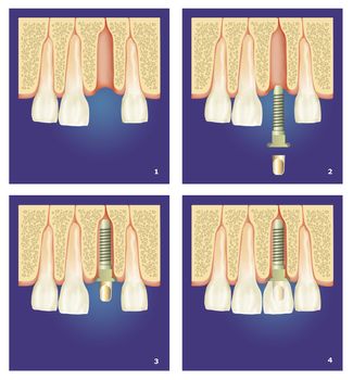 dental prosthesis intervention in four steps implantology