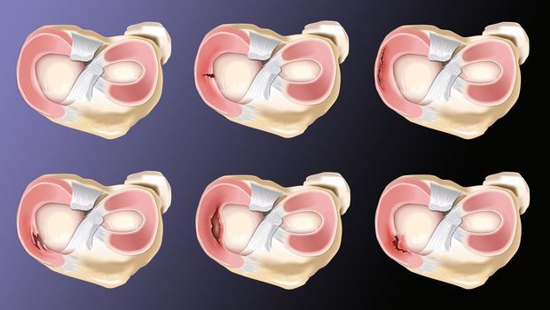 various types of injuries to the meniscus of the knee surgical operation on the meniscus for breach