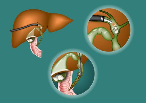 schematic drawing of lithotripsy in gall bladder