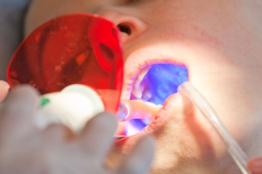 Dentinst making composite tooth fillings with UV light to the patient
