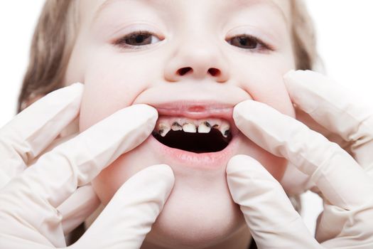 Dental medicine and healthcare - dentist examining little child boy patient open mouth showing caries teeth decay