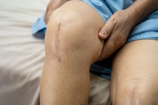 Asian senior or elderly old lady woman patient show her scars surgical total knee joint replacement Suture wound surgery arthroplasty on bed in nursing hospital ward, healthy strong medical concept.