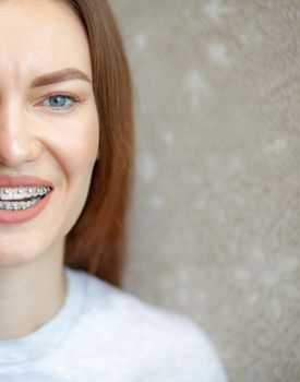 The smile of a young and beautiful girl with braces on her white teeth. Straightening of crooked teeth with the help of a bracket system. Malocclusion. Dental care. Smooth teeth and a beautiful smile