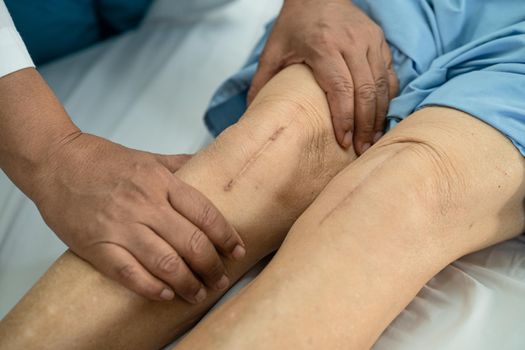 Asian senior or elderly old lady woman patient show her scars surgical total knee joint replacement Suture wound surgery arthroplasty on bed in nursing hospital ward, healthy strong medical concept.