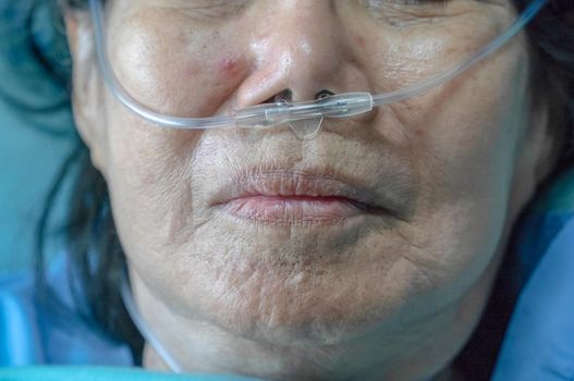 Elderly woman with nasal breathing tube to help with her breathing