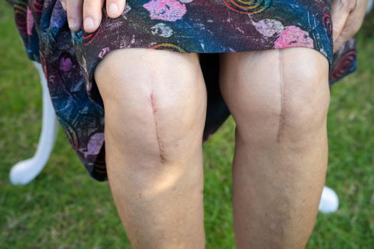 Asian senior lady old woman patient show her scars surgical total knee joint replacement.