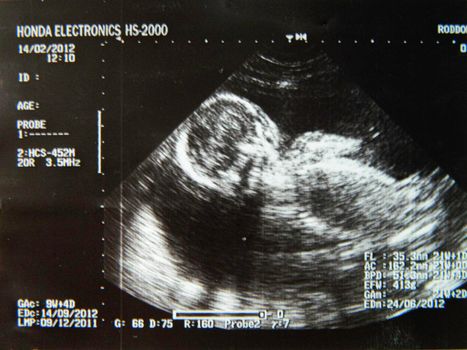 Obstetric Ultrasonography Ultrasound Echography of a fourth month fetus. High quality photo