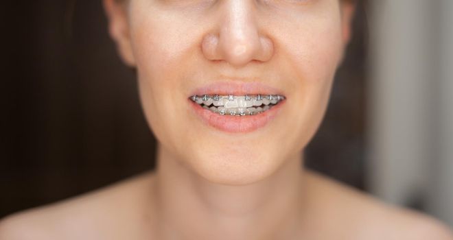 The smile of a young and beautiful girl with braces on her white teeth. Straightening of crooked teeth with the help of a bracket system. Malocclusion. Dental care. Smooth teeth and a beautiful smile