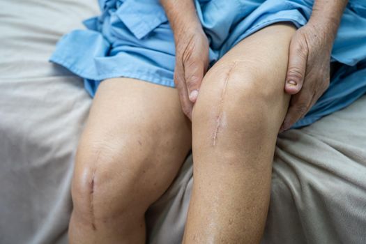 Asian senior or elderly old lady woman patient show her scars surgical total knee joint replacement Suture wound surgery arthroplasty on bed in nursing hospital ward, healthy strong medical concept.