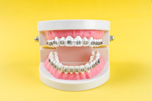 tooth model with metal wire dental braces and equipment on yellow background