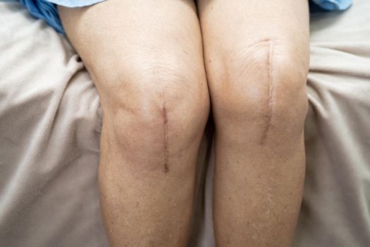 Asian senior or elderly old lady woman patient show her scars surgical total knee joint replacement Suture wound surgery arthroplasty on bed in nursing hospital ward, healthy strong medical concept.