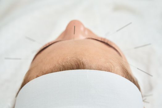 Young woman having an acupuncture treatment therapy on face in spa salon. Alternative medicine and therapy concept