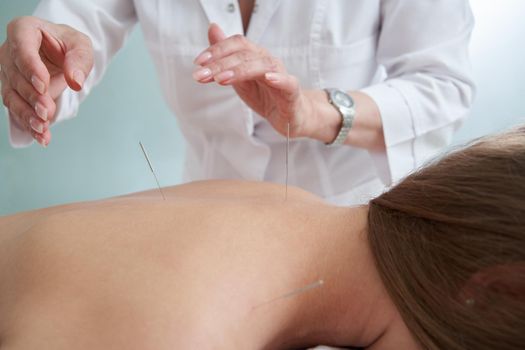 Doctor puts needles into female back on the acupuncture therapy in beauty salon. Alternative Medicine concept