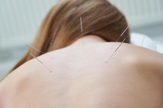 Female back with needles on the acupuncture treatment therapy in a spa salon. Alternative Medicine concept