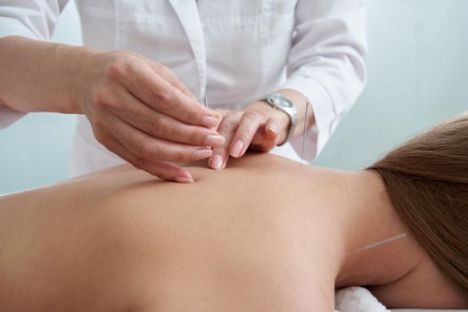 Doctor puts needles into female back on the acupuncture therapy in beauty salon. Alternative Medicine concept