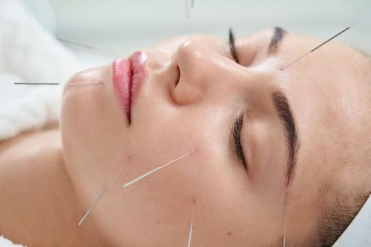 Young woman having an acupuncture treatment therapy on face in spa salon. Alternative medicine and therapy concept