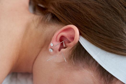 Beautiful young woman relaxing on a bed having acupuncture treatment with needles in and around her ear. Alternative Therapy concept