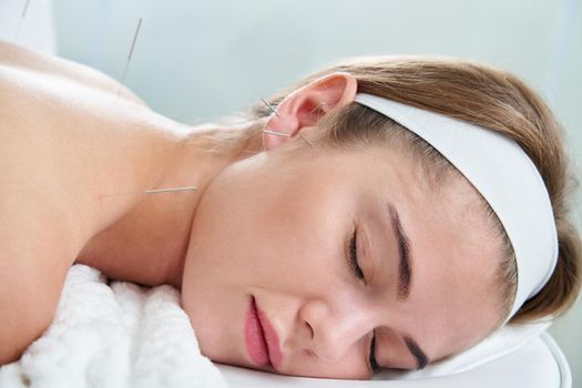 Beautiful young woman relaxing on a bed having acupuncture treatment with needles in and around her ear. Alternative Therapy concept