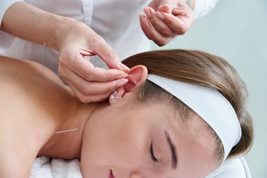 Beautiful young woman relaxing on a bed having acupuncture treatment with needles in and around her ear. Alternative Therapy concept